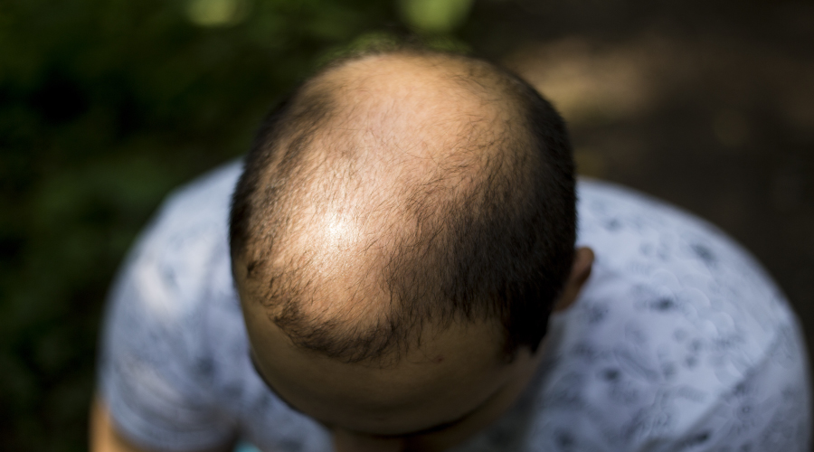 male baldness