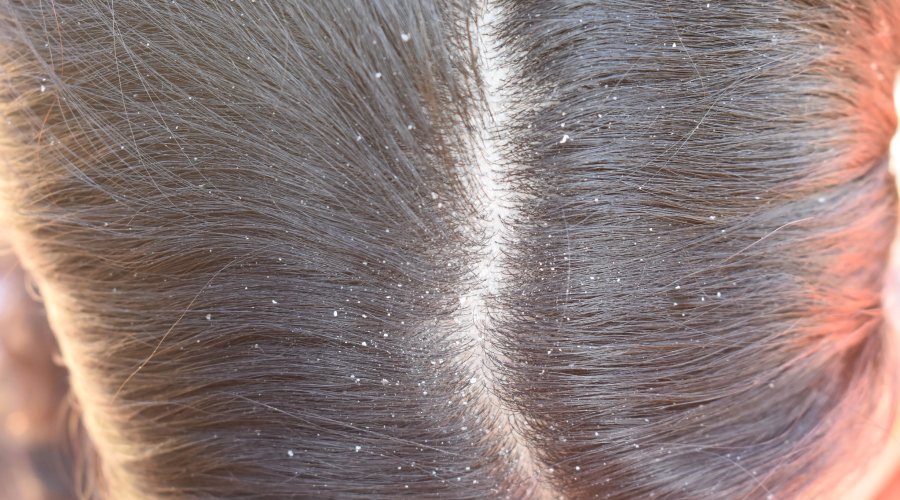 Dandruff and dry scalp