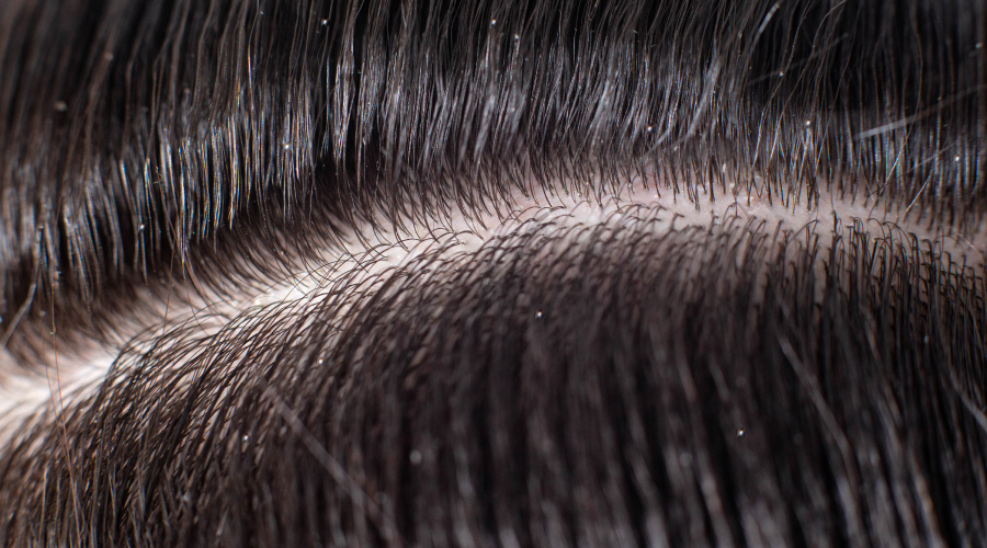 dry scalp