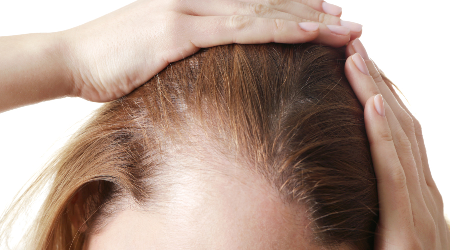 female pattern baldness