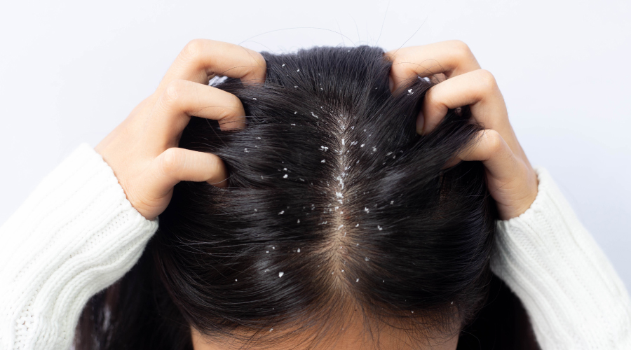 Dandruff