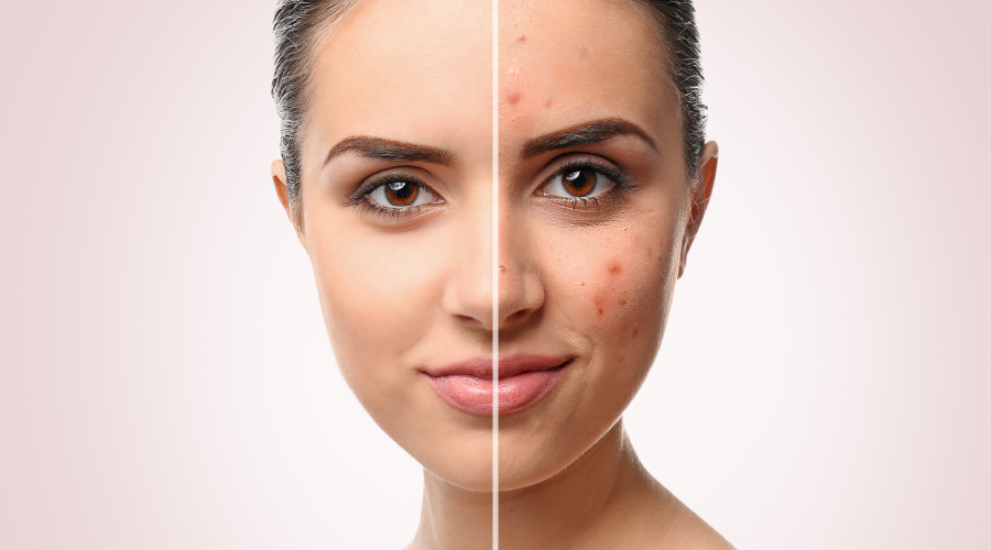 how to remove pimple scars naturally