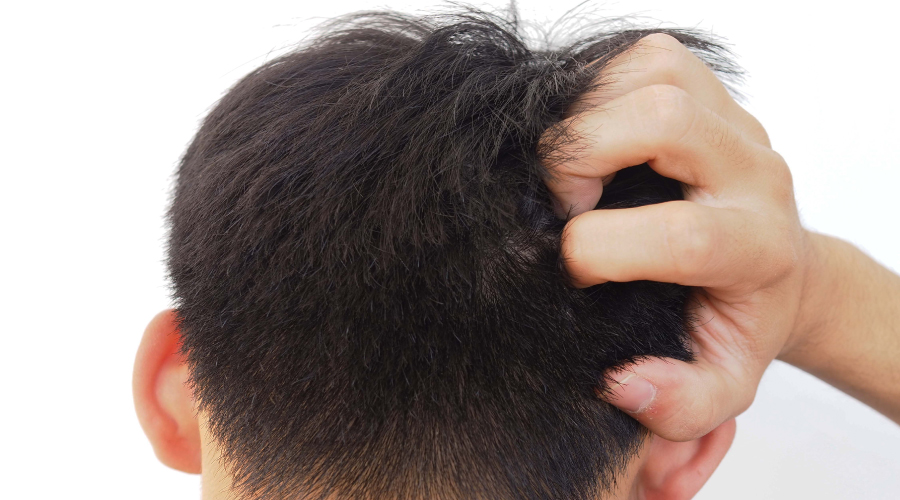 head lice