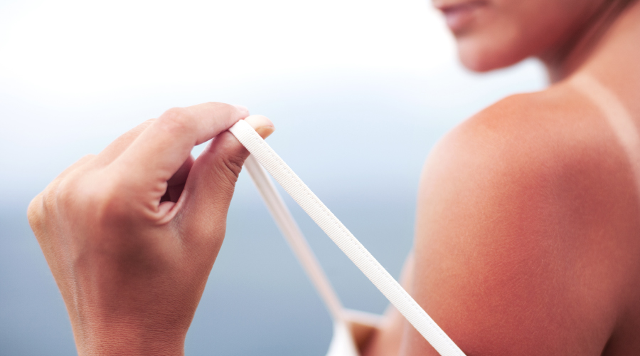 Understanding Sun Rash: Causes, Symptoms, and Home Remedies