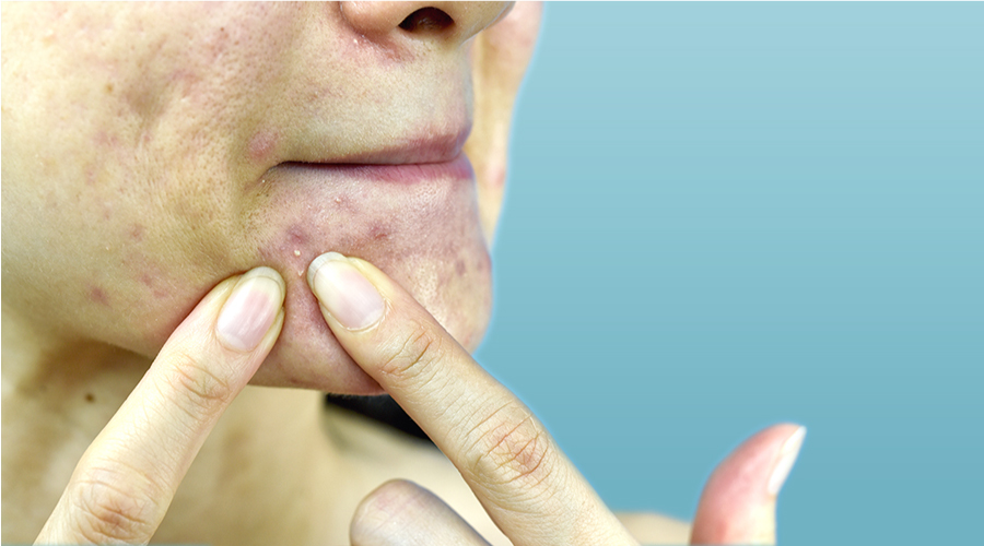 Get Rid of Whiteheads: Best Skin Care Tips That Work