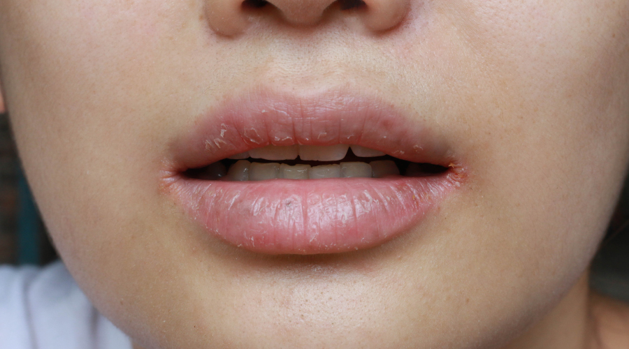 Remedies for chapped lips
