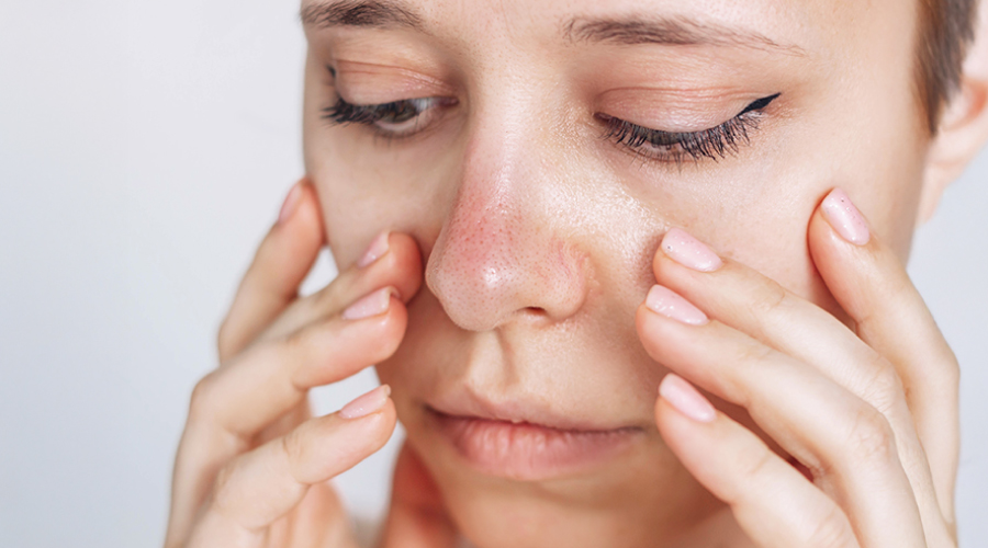 What are blackheads