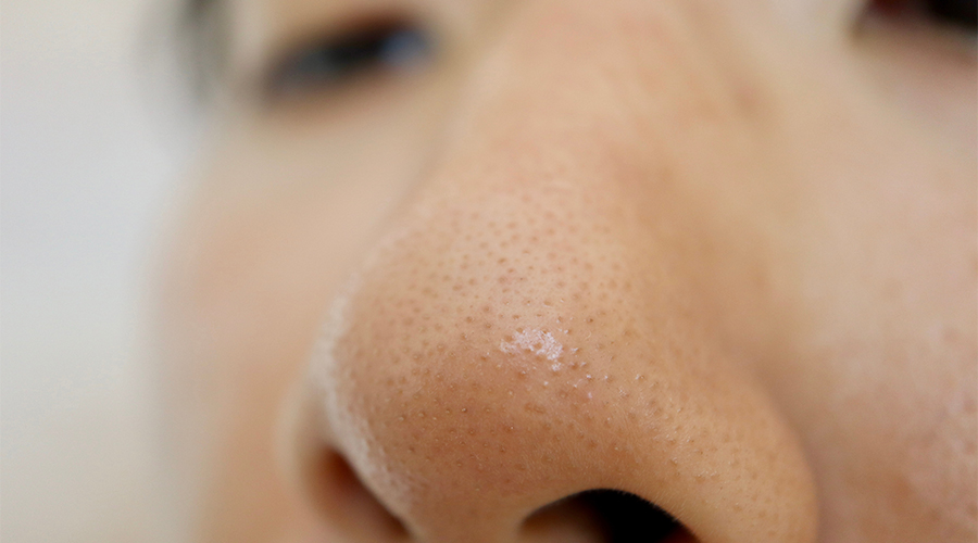 Struggling with a Strawberry Nose? Here’s How to Get Rid of Blackheads on Nose Fast