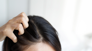 Hormone imbalance hair loss
